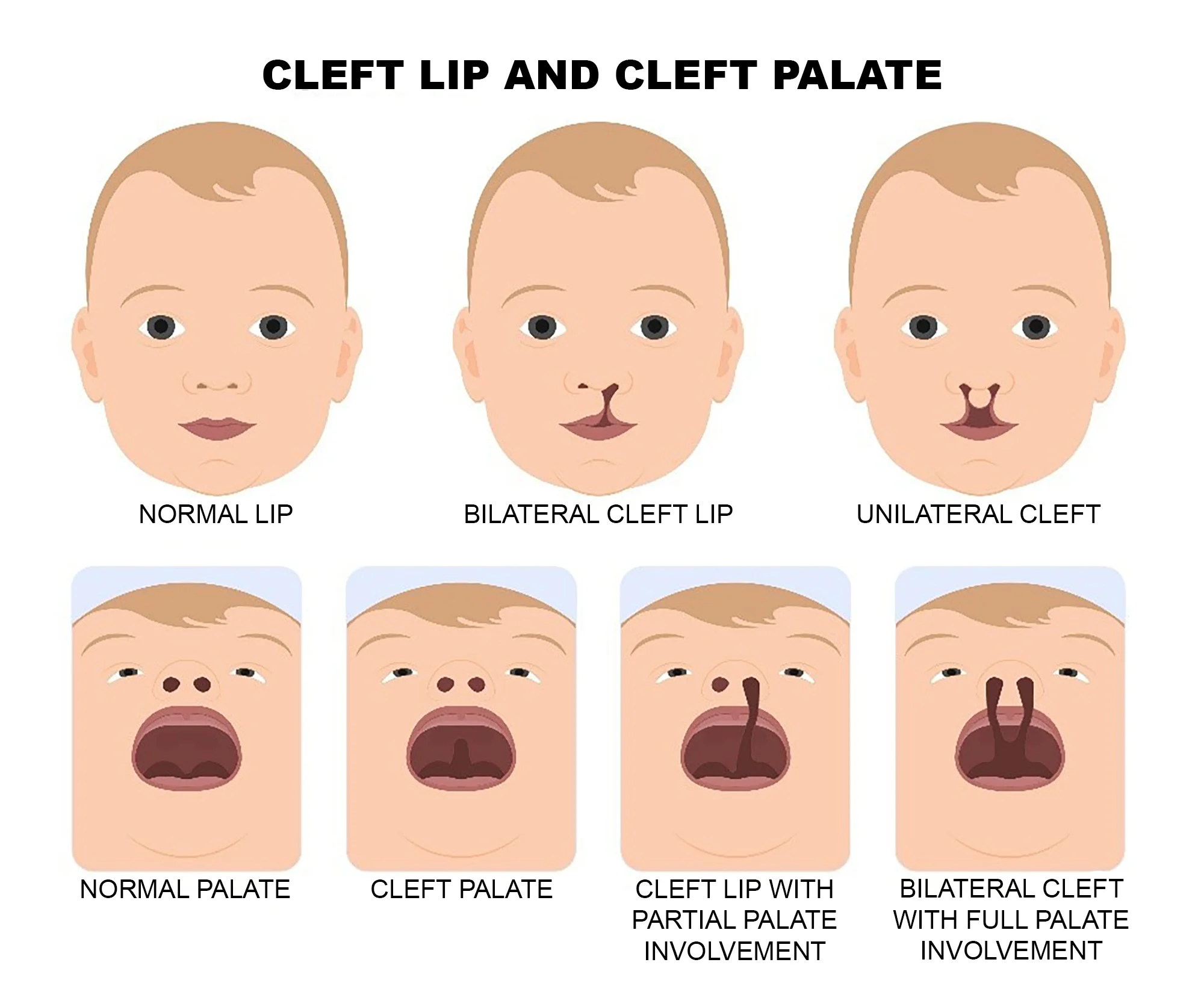 Celah Bibir dan Langit-langit
