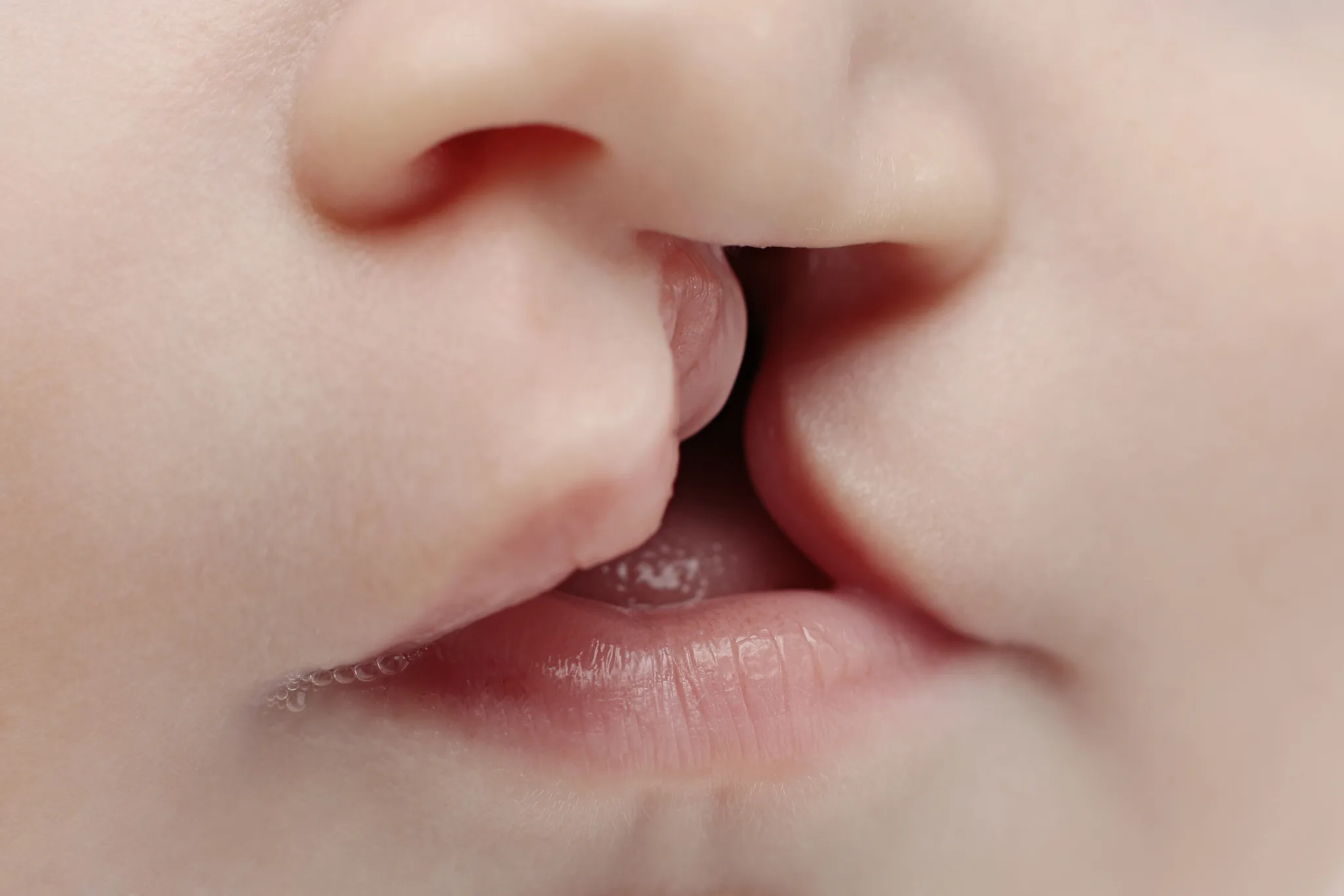 CELAH BIBIR DAN LANGIT-LANGIT PADA ANAK