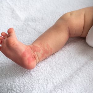 MENGENAL ALERGI PADA BAYI