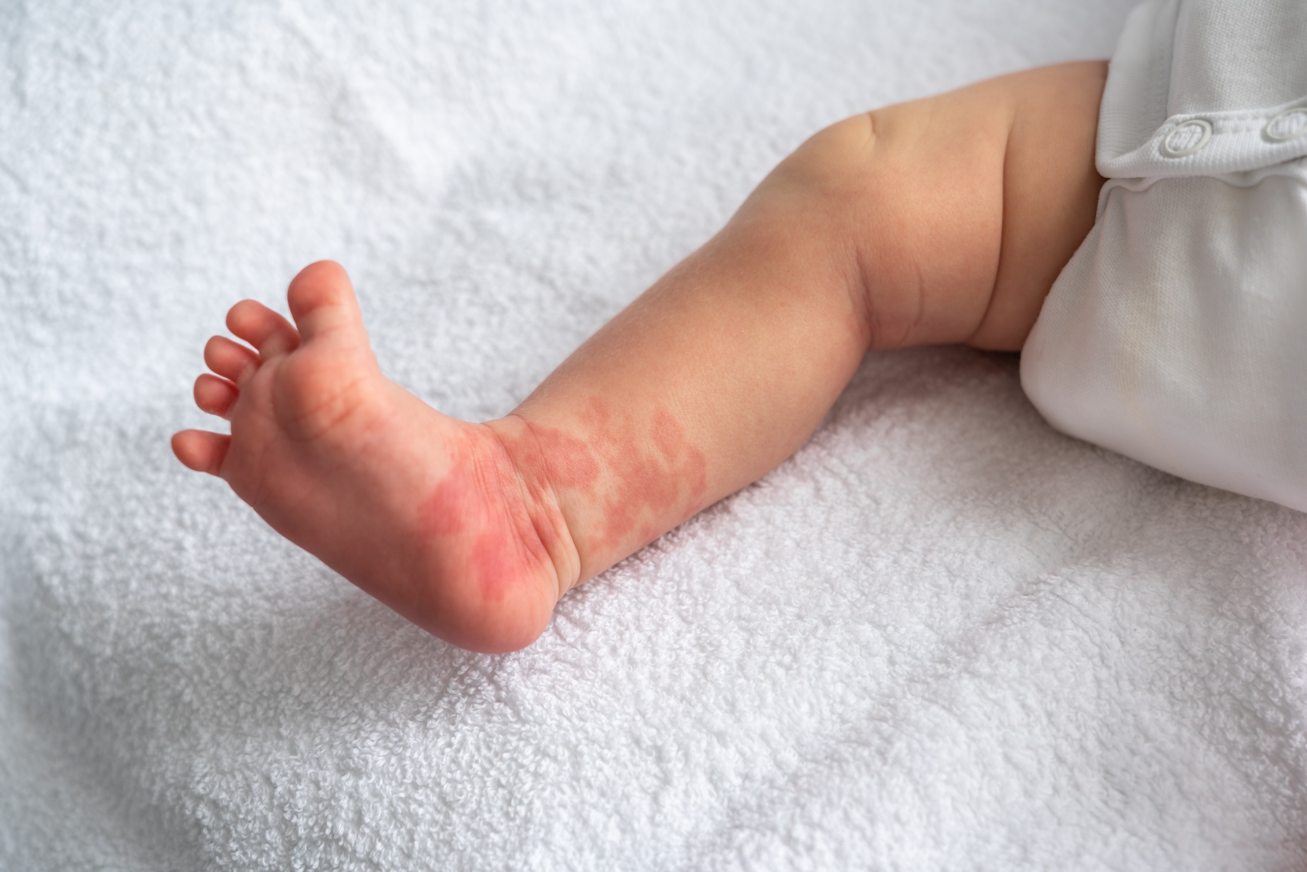 MENGENAL ALERGI PADA BAYI