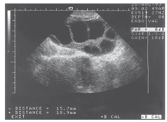 IVF