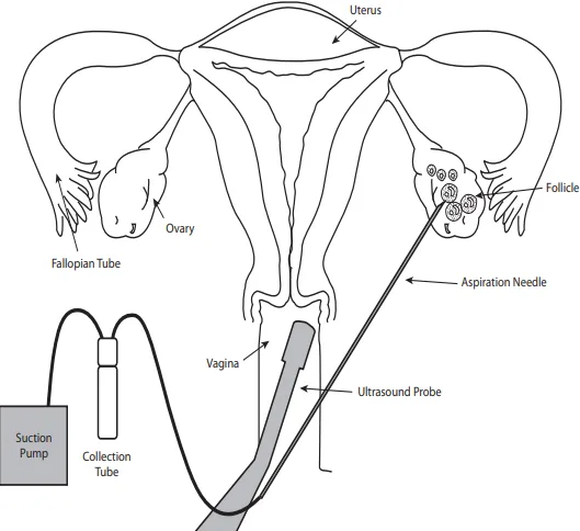 IVF