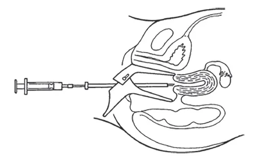 IVF